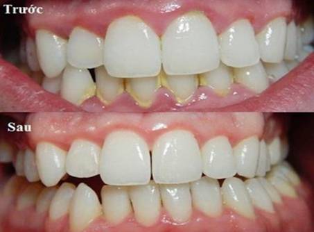 ranmienh6 1 7 SAI LẦM NGHIÊM TRỌNG TRONG CÁCH CHĂM SÓC RĂNG MIỆNG HÀNG NGÀY